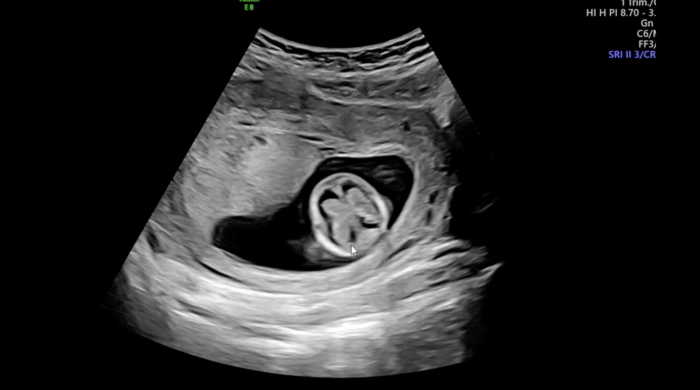 Ultrasound image of brain with what looks like a butterfly.