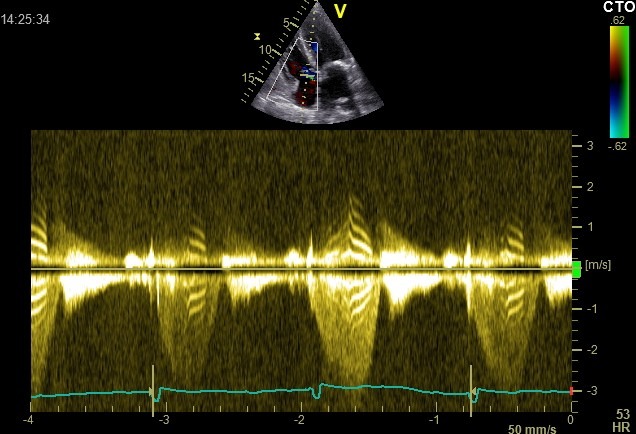 Picture of the tiger stripe sign on a Doppler