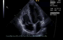 1_Tricusid_valve_endocarditis_4ch_1.png