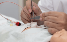 Image of doctor placing umbilical vein catheter.