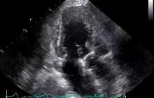 ultrasound, echo, cardiography, sonography