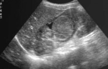 Sagittal image of the right kidney