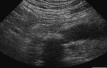 Sagittal sonogram of the right lower quadrant