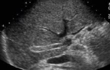 Transverse sonogram of the liver