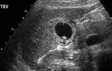 Transverse view of the gallbladder