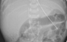 Abdominal X-ray of an infant.