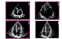 Ultrasound image of left atrium.