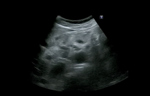 Pancreatic cancer ultrasound loop.