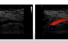 VLE case aortoiliac stenosis right common femoral artery loop.