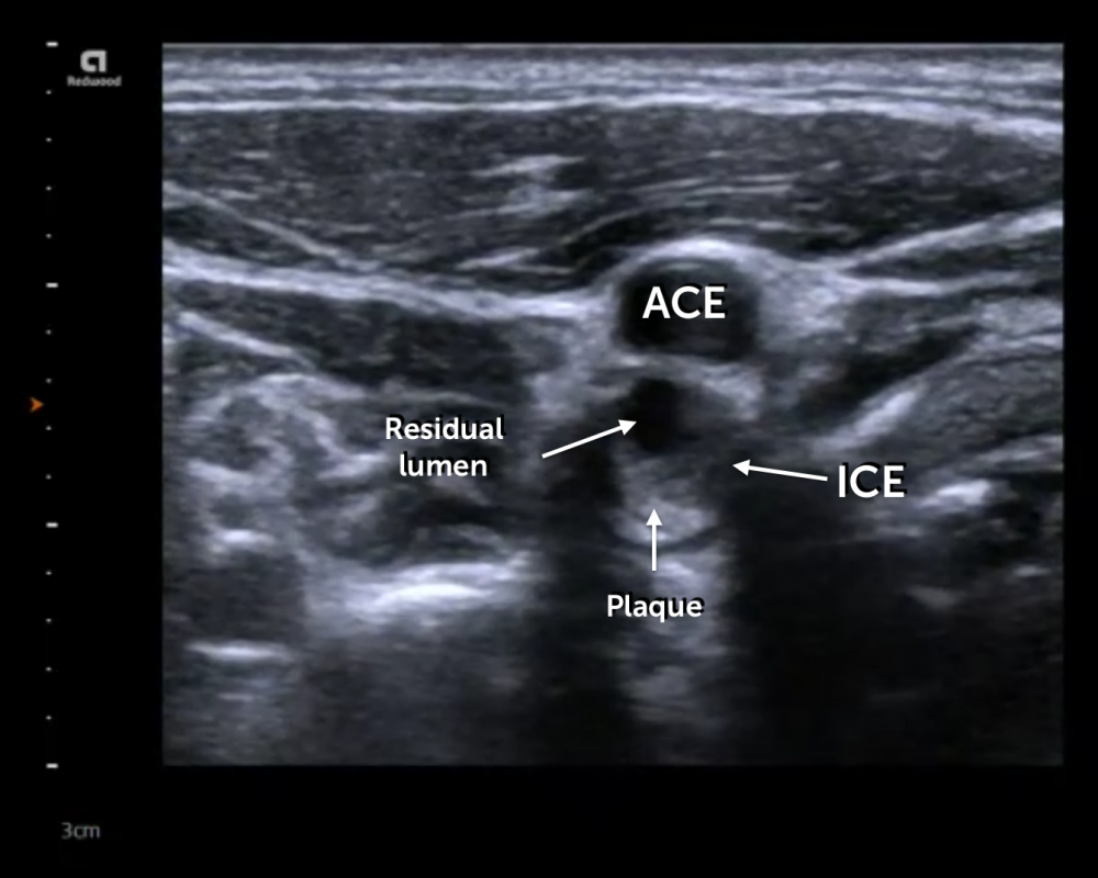 11.3%20Transverse%20stenosis.png